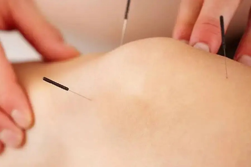 Northcare Physio dry needling treatment