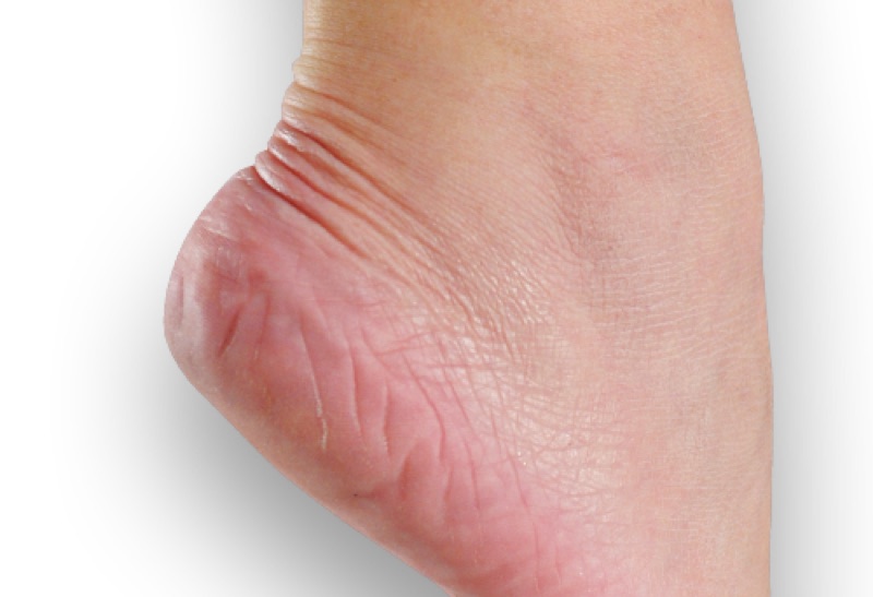 O'Keeffe's Healthy Feet result, before and after
